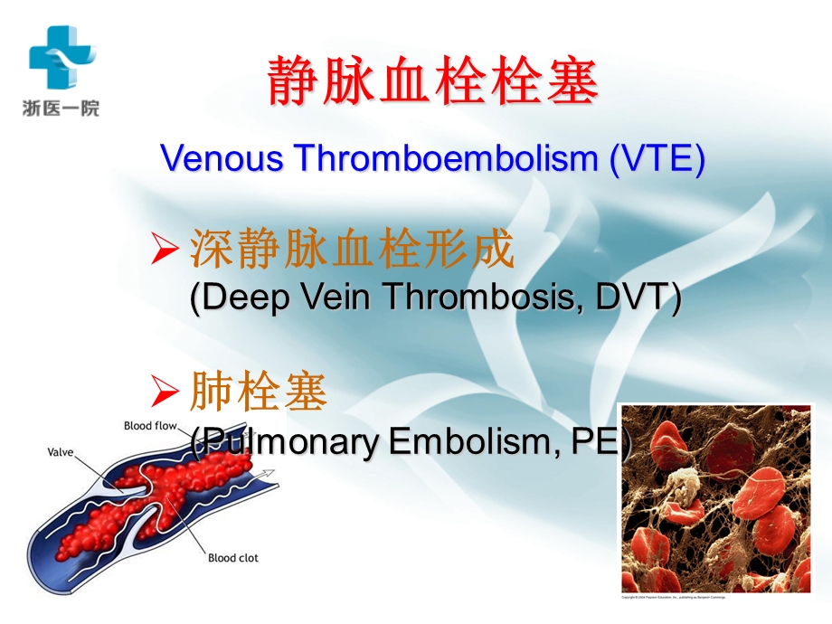 DVT诊断和治疗课件.ppt_第2页