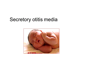 耳鼻咽喉科学英文版ppt课件 secretory otitis .ppt