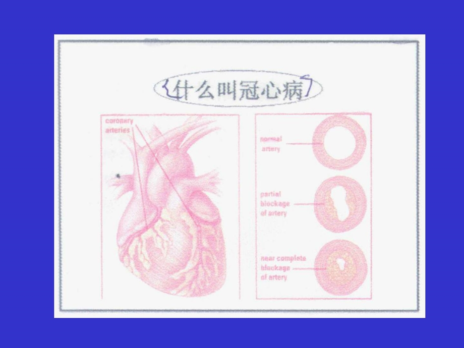 冠芥蒂防备治疗康复课件.ppt_第2页