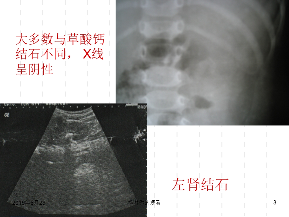 与食用受污染三鹿牌婴幼儿配方奶粉相关的婴幼儿泌尿系统结石诊疗方案课件.pptx_第3页