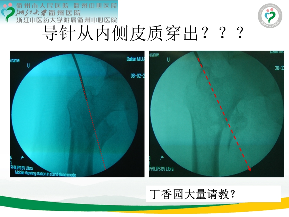 pfna治疗股骨转子间骨折牵引床手术体位技巧 课件.ppt_第3页