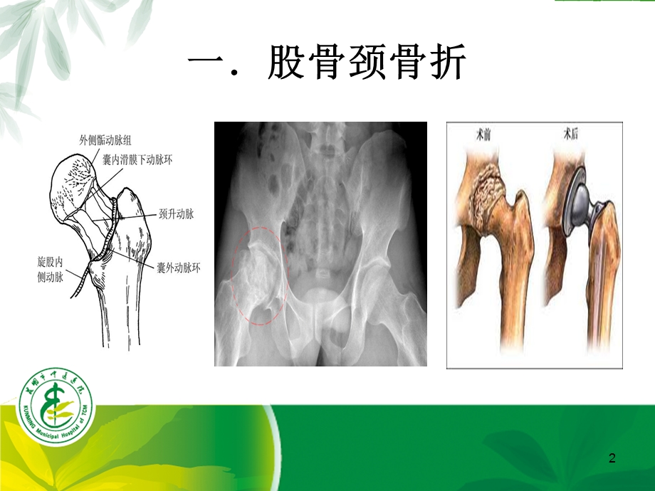 股骨颈骨折手术患者多模式镇痛治疗课件.ppt_第2页