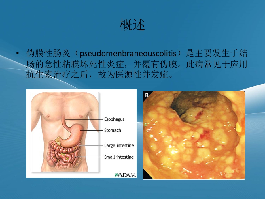 伪膜性肠炎课件.ppt_第2页