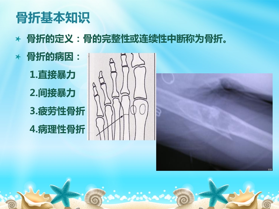 胫腓骨骨折 ppt课件.ppt_第2页