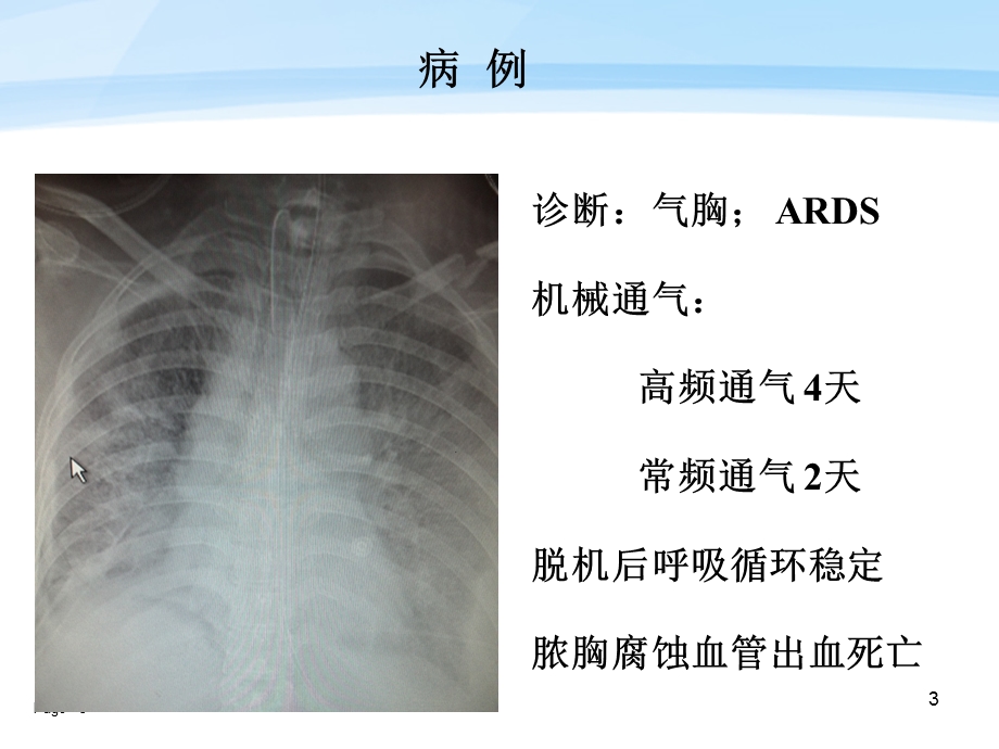 高频通气临床应用体会课件.ppt_第3页