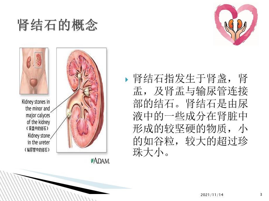 一例肾结石伴术后感染性休克患者护理查房课件.ppt_第3页