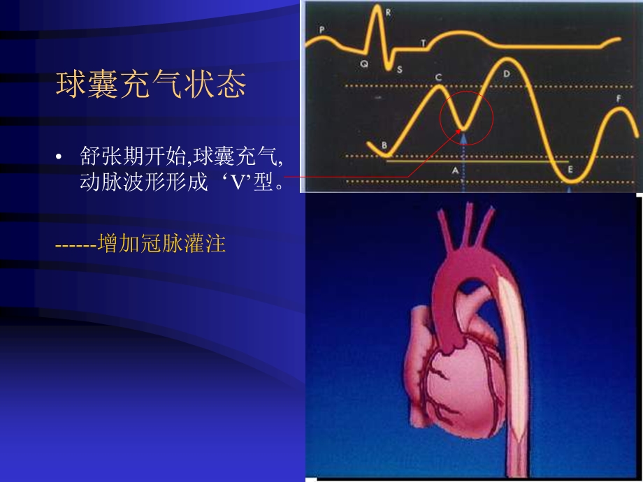 IABP使用注意事项解读课件.ppt_第3页