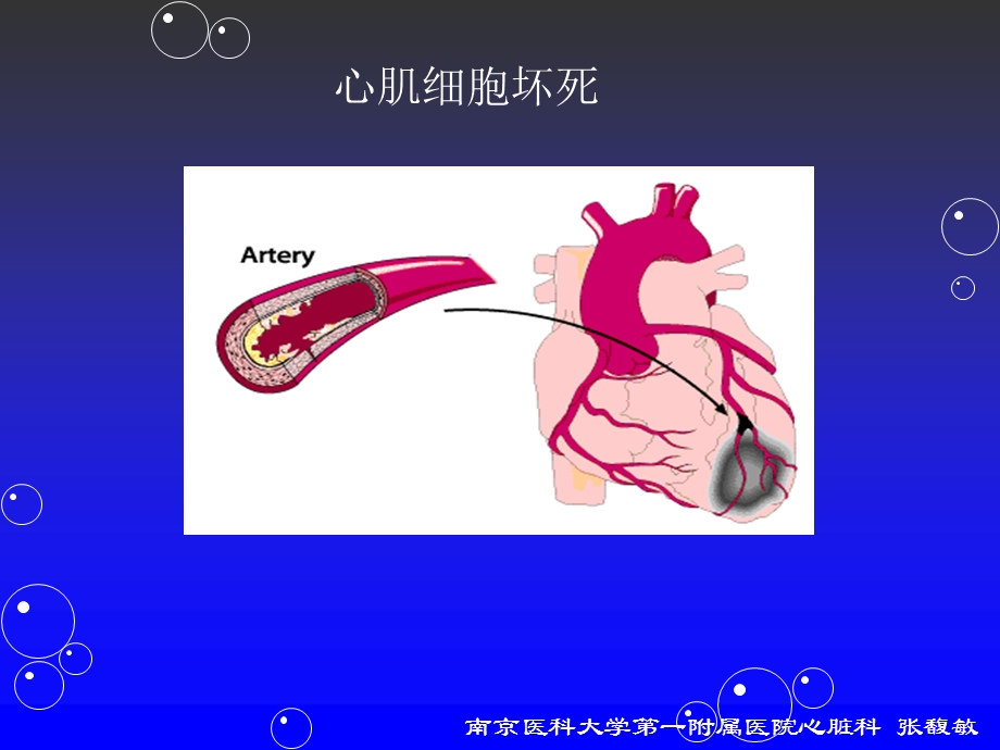 自体骨髓干细胞移植治疗冠心病的临床研究课件.ppt_第3页