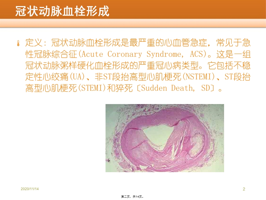 一例冠状动脉血栓患儿护理查房课件.ppt_第2页