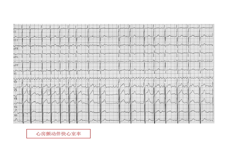 规培考试的资料心电图课件.ppt_第2页