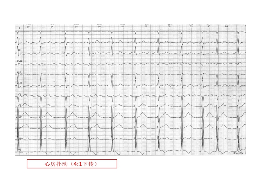 规培考试的资料心电图课件.ppt_第3页