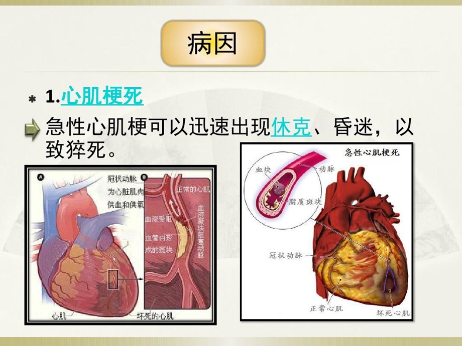 突发性猝死的应急预案及流程讲课稿课件.ppt_第3页