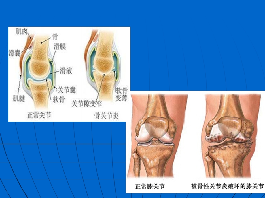 膝关节骨性关节炎课件.pptx_第3页