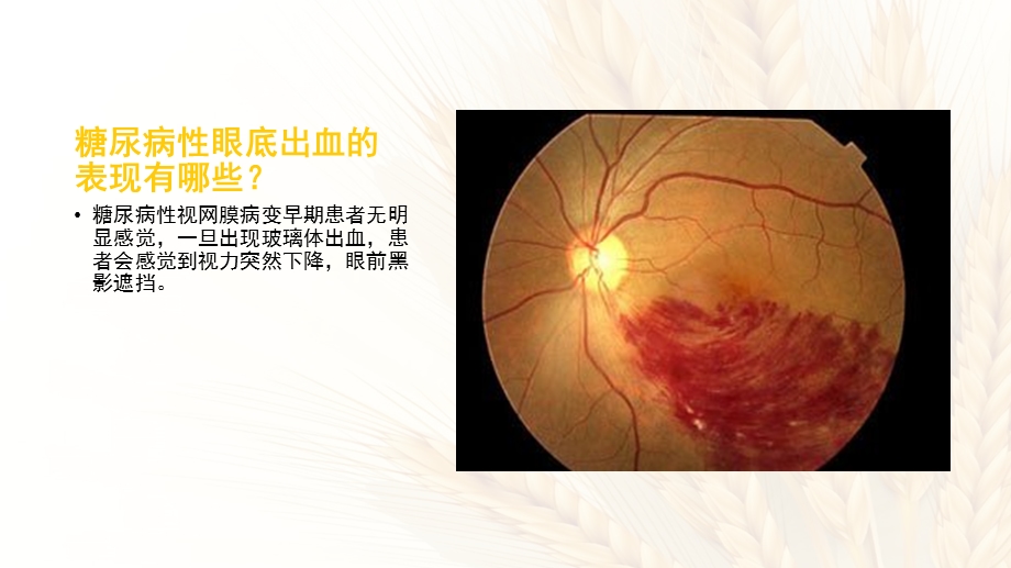 糖尿病眼底出血的护理ppt课件.pptx_第3页