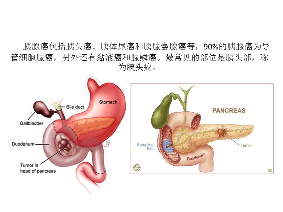 胰腺癌参考ppt课件.ppt_第3页