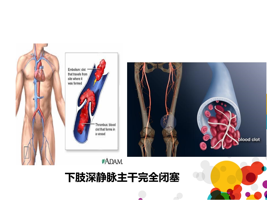 下肢深静脉血栓(成稿)教学教材课件.ppt_第3页