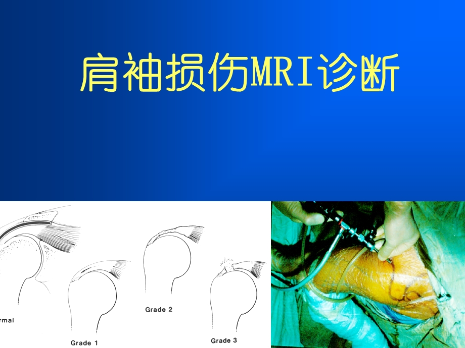 肩袖损伤MRI诊断课件.ppt_第1页