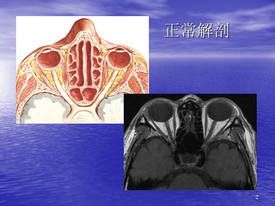眼眶及眼球病变MR表现课件.ppt_第2页