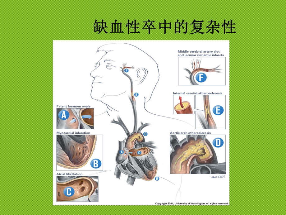 脑梗死的检查、诊断与治疗课件.ppt_第2页