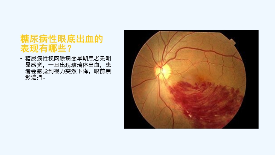 糖尿病眼底出血的护理课件.pptx_第3页