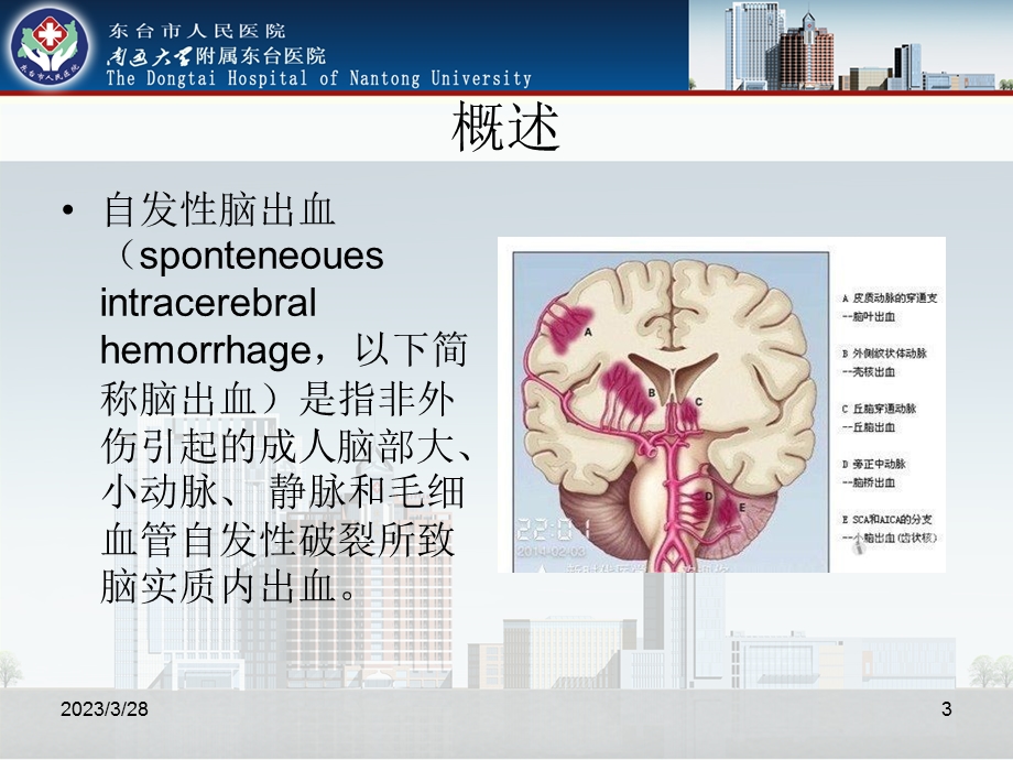 自发性脑出血诊断治疗新进展课件.ppt_第3页