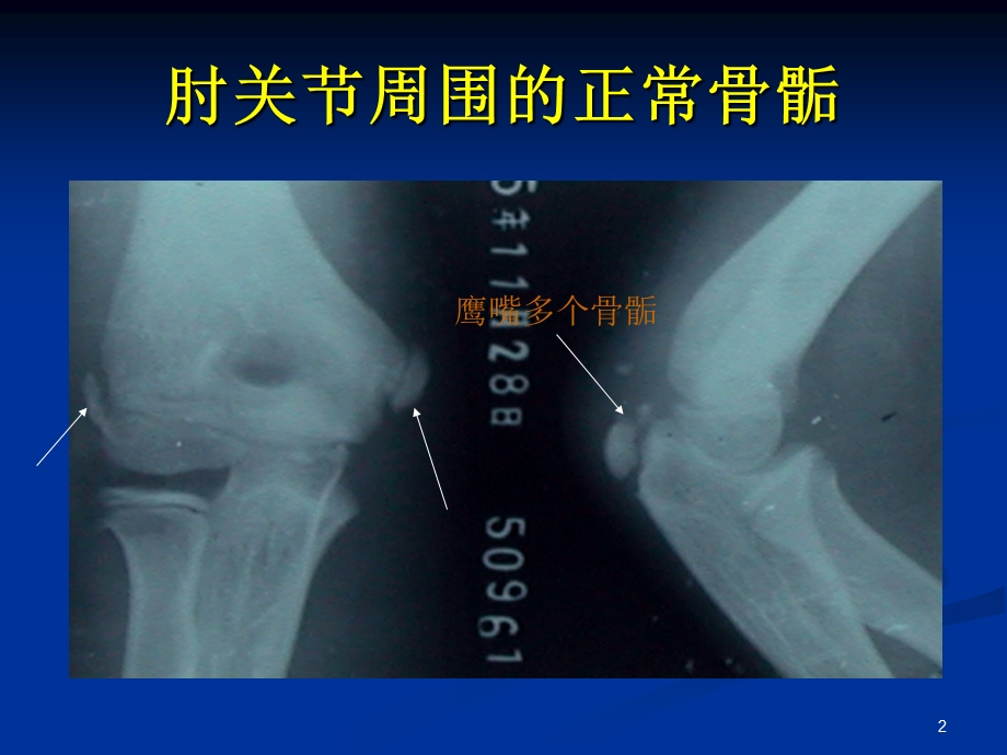 肱骨外髁骨折课件.ppt_第2页