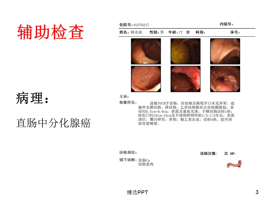 直肠癌术后吻合口出血课件.ppt_第3页