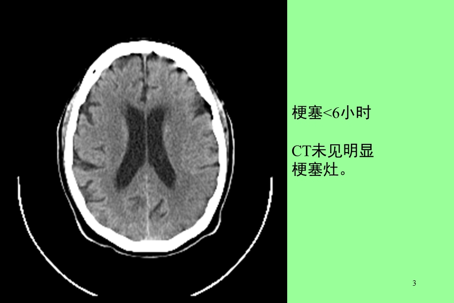 脑栓塞护理查房优质ppt课件.ppt_第3页