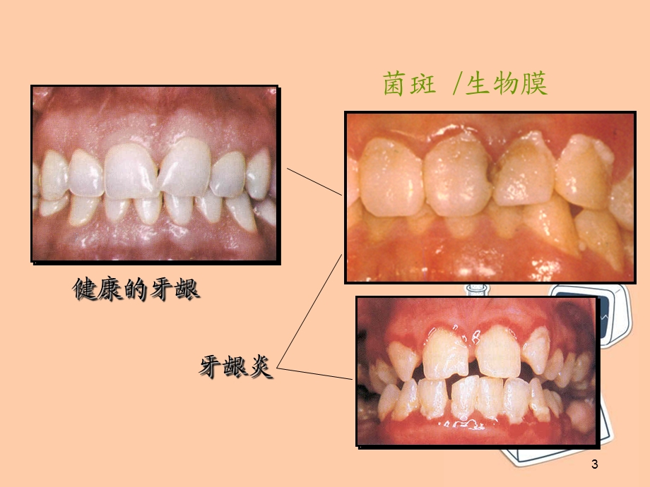 牙周炎与全身疾病(慢病发言)学习ppt课件.ppt_第3页