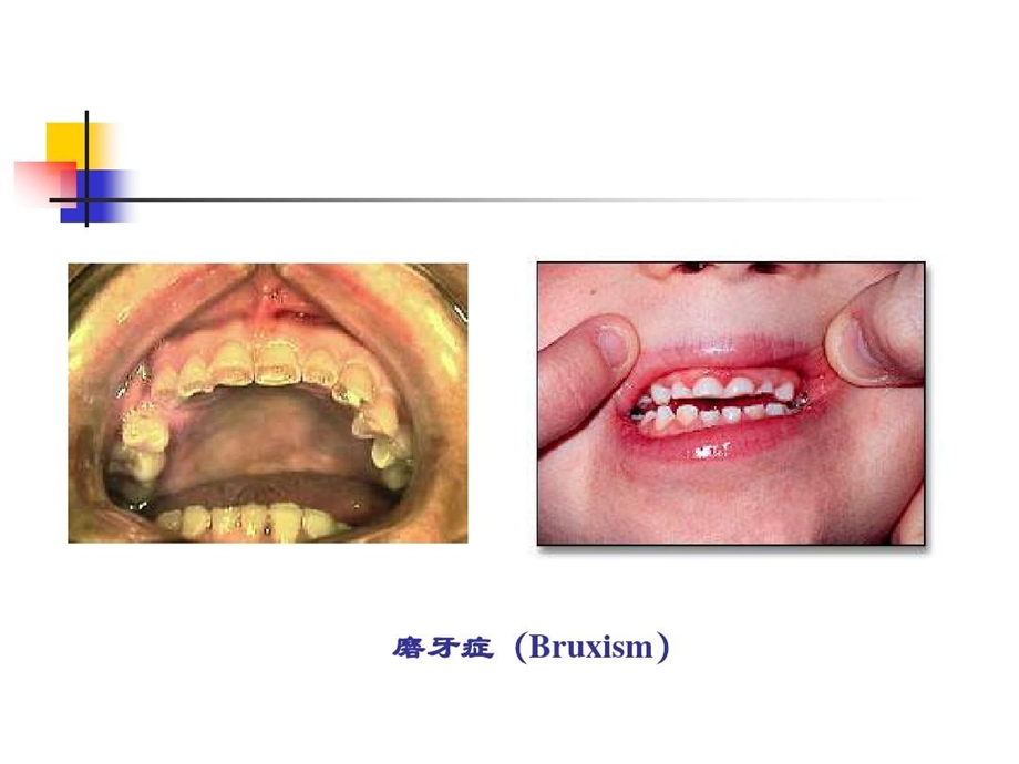 磨牙症的临床症状和治疗手段课件.ppt_第2页