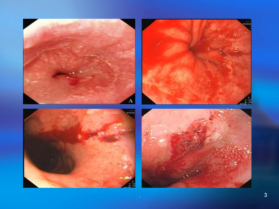 贲门粘膜撕裂课件.pptx_第3页