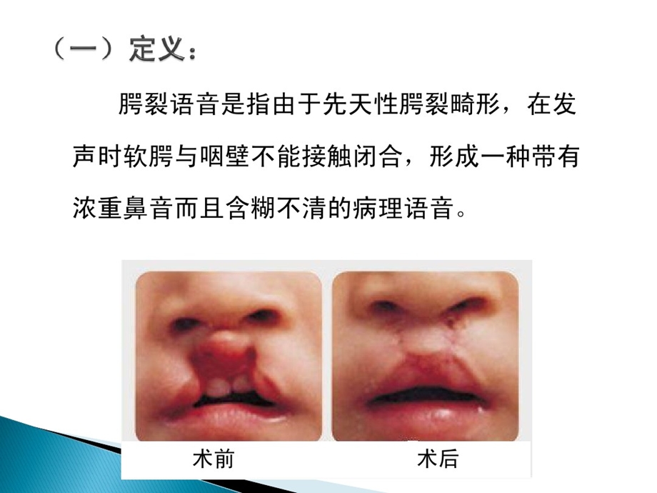 腭裂术后语音训练课件.ppt_第3页