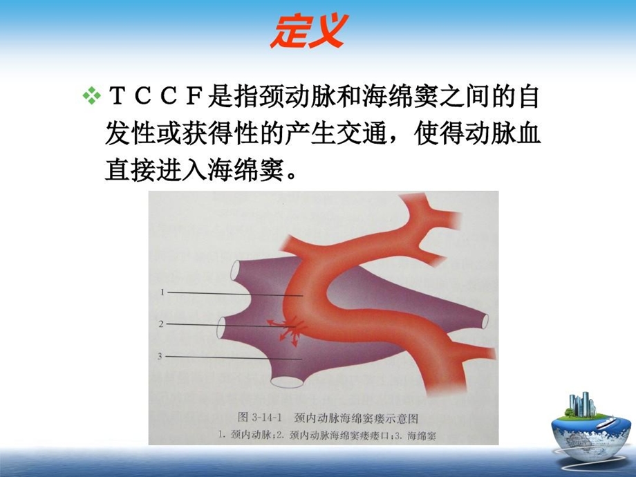 创伤性颈动脉海绵窦瘘课件.ppt_第3页