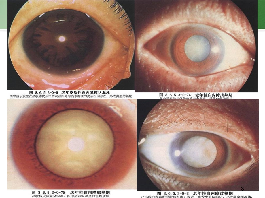 小切口白内障手术课件.ppt_第3页