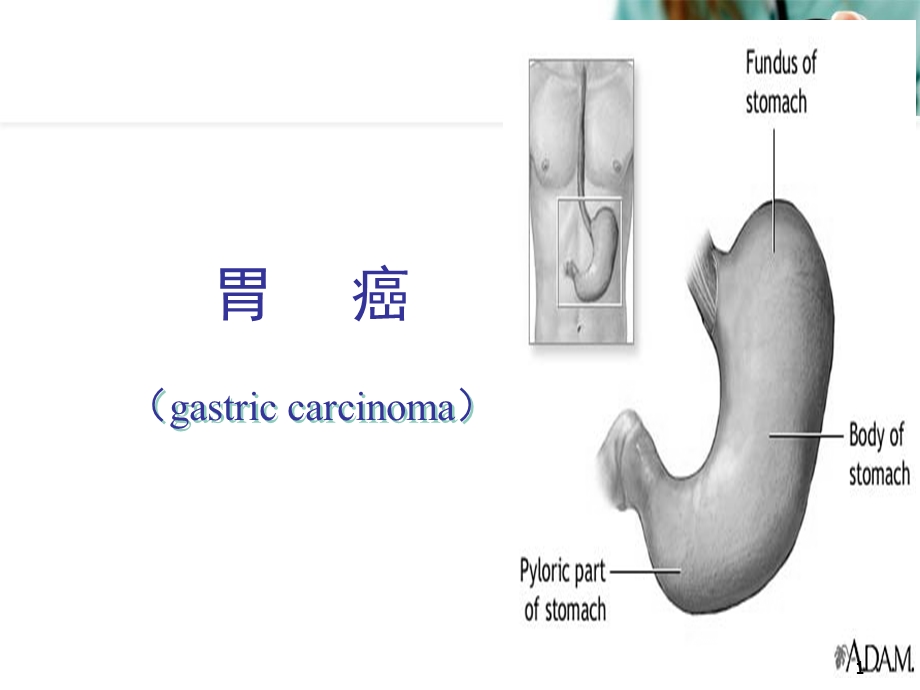 胃癌教学课件幻灯片课件.ppt_第1页