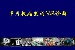 膝关节半月板病变MR诊断课件.ppt