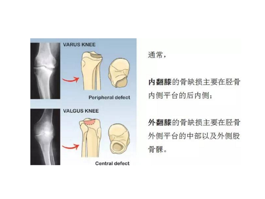 全膝关节置换中骨缺损的分型和处理课件.ppt_第2页