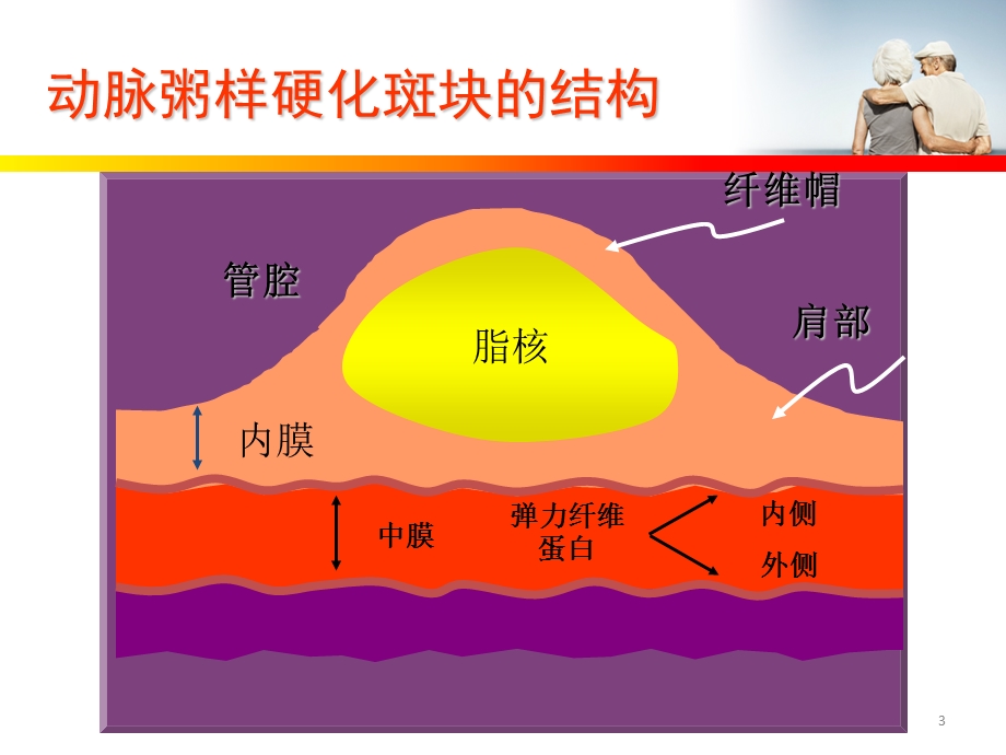 颈动脉斑块与冠心病患者教育课件汇编.ppt_第3页