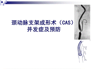 颈动脉CAS并发症与预防课件.ppt