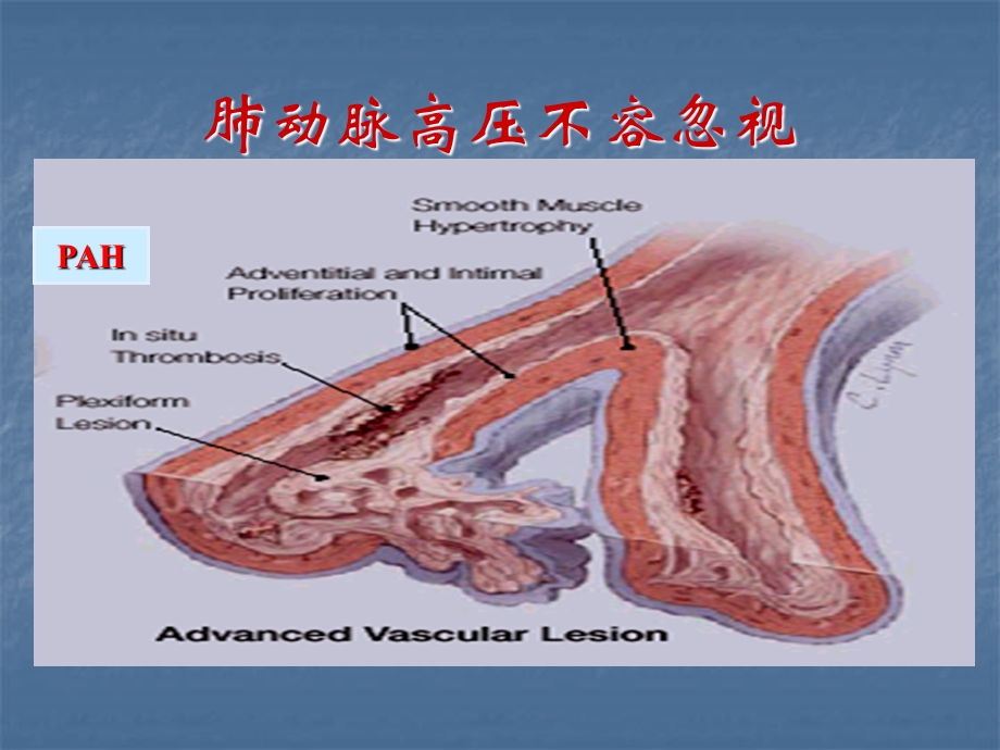 SLE-PAH诊治共识解读课件.ppt_第2页