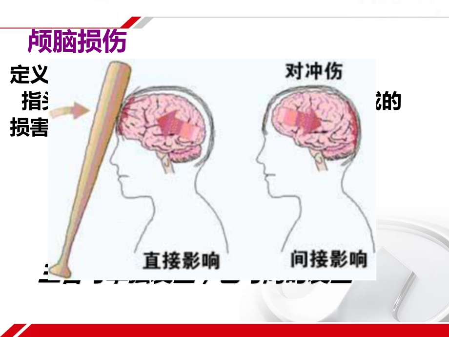 颅脑损伤病人的护理参考ppt课件.ppt_第2页