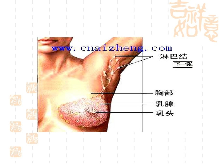 乳腺癌术后淋巴水肿机理及预防治疗课件.ppt_第3页