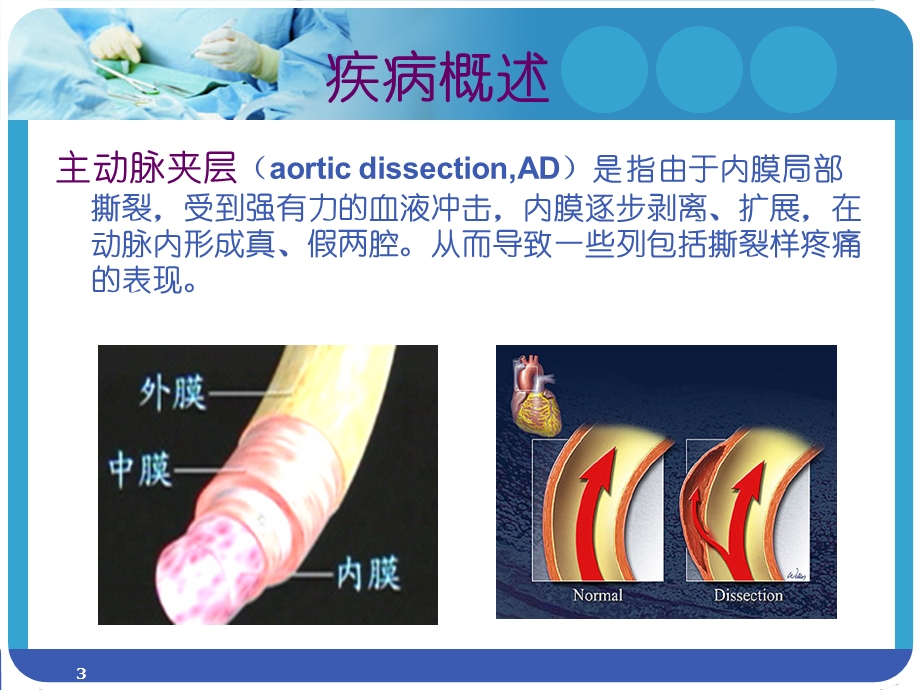 主动脉夹层腔内隔绝术术后患者的护理参考ppt课件.ppt_第3页