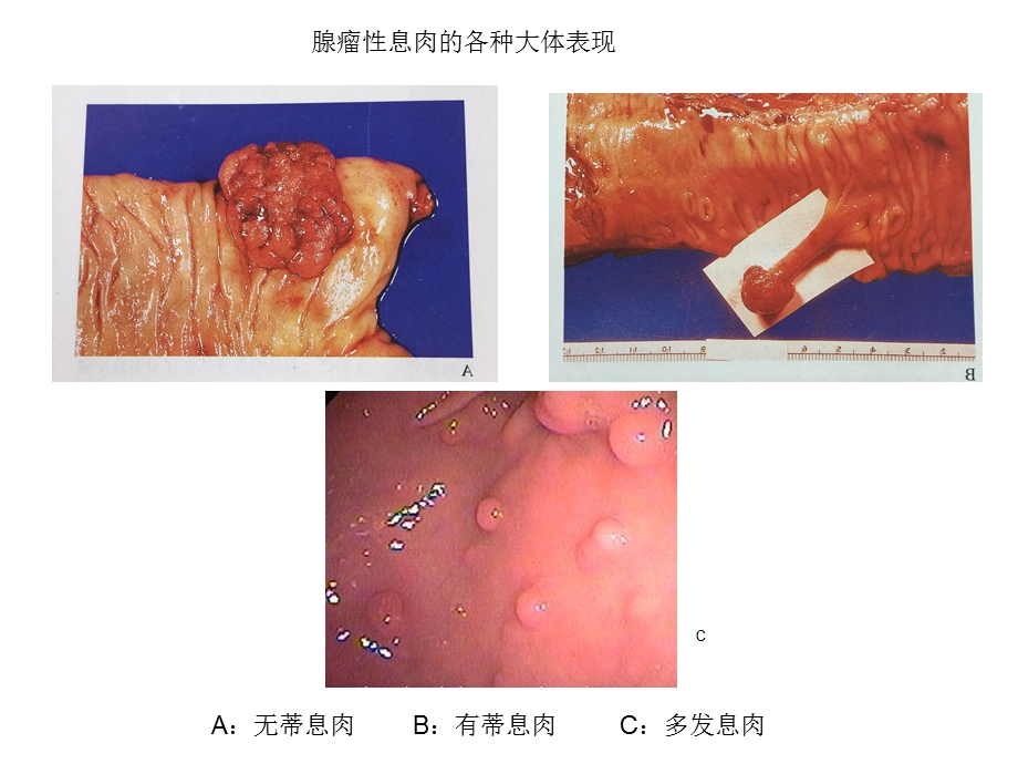 腺瘤性息肉汇编课件.ppt_第2页