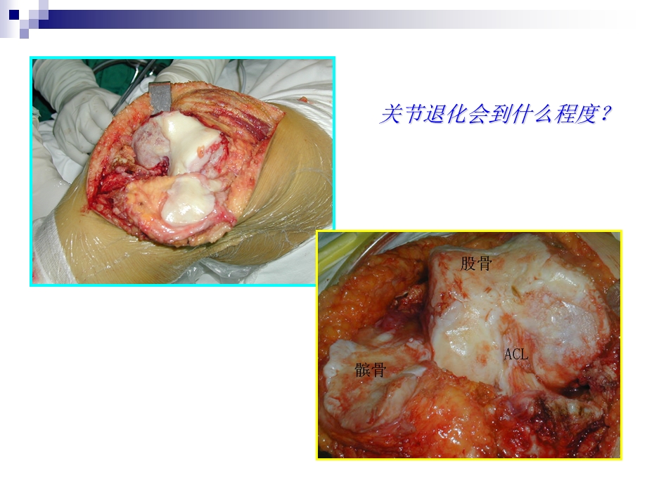 膝关节骨性关节炎的中医治疗汇编课件.ppt_第3页