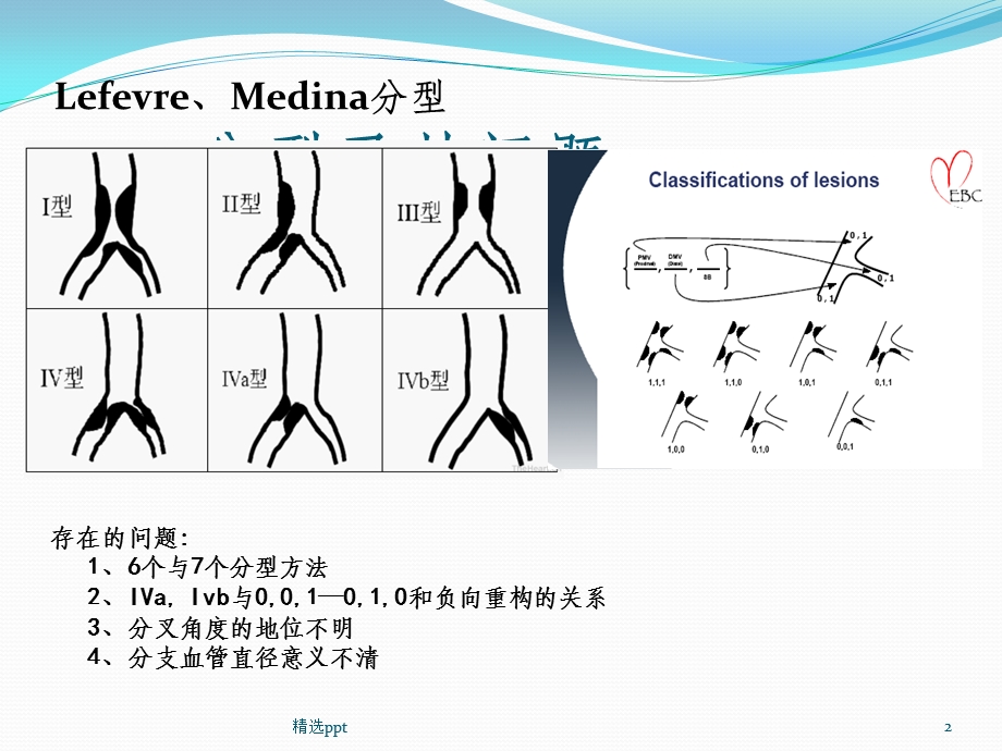 分叉病变的分型和术式选择课件.pptx_第2页