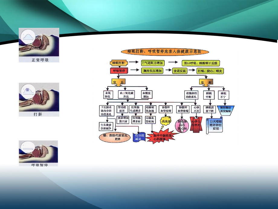 阻塞性睡眠呼吸暂停综合征的健康教育汇编课件.ppt_第2页