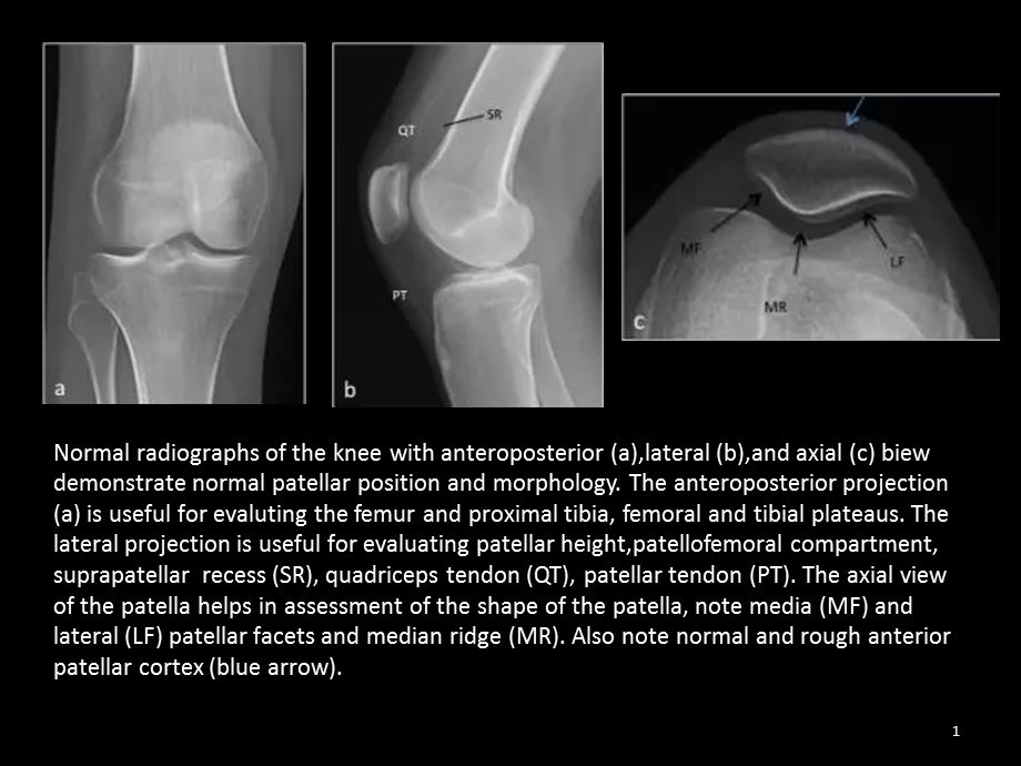 髌骨病变的影像学表现课件.ppt_第1页