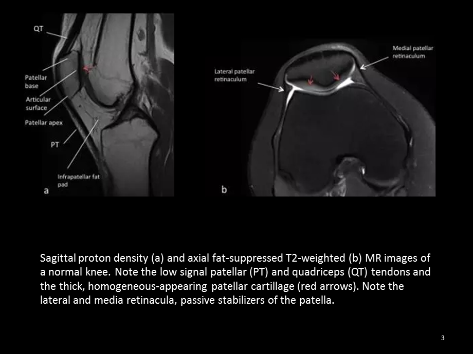 髌骨病变的影像学表现课件.ppt_第3页