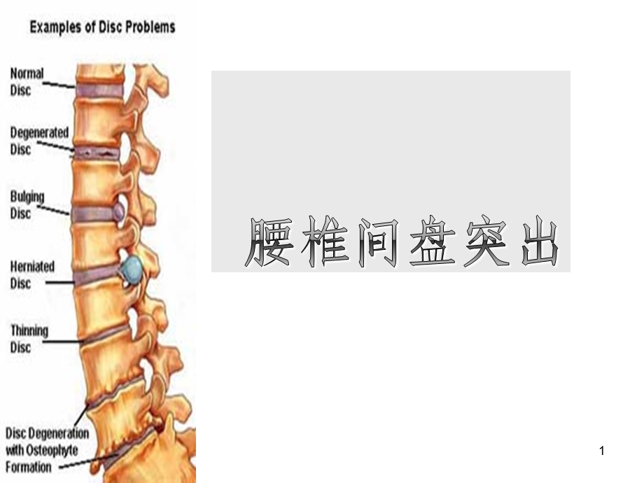 (腰椎间盘突出与腰肌劳损)运动康复幻灯片ppt课件.ppt_第1页